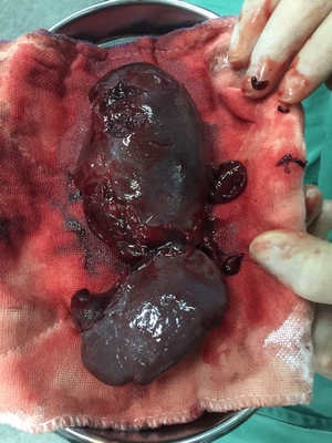 14歲男孩玩耍摔倒，脾臟破裂，險(xiǎn)些喪命！