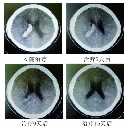 腦出血你不得不引起重視的疾?。。?！