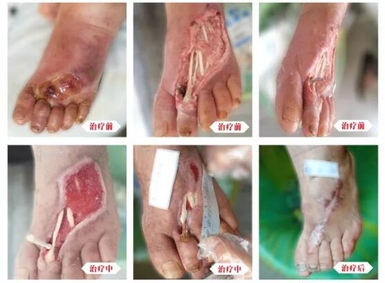 糖尿病并發(fā)癥有多可怕，及時治療糖尿病足避免截肢！