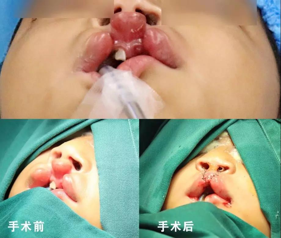 唇腭裂盡早治療消除孩子自卑心理，快樂(lè)成長(zhǎng)！