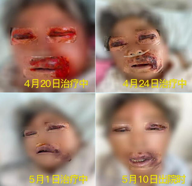 膿毒血癥（急性頜面部蜂窩組織炎）多學(xué)科聯(lián)合會診，幫助患者成功治愈！