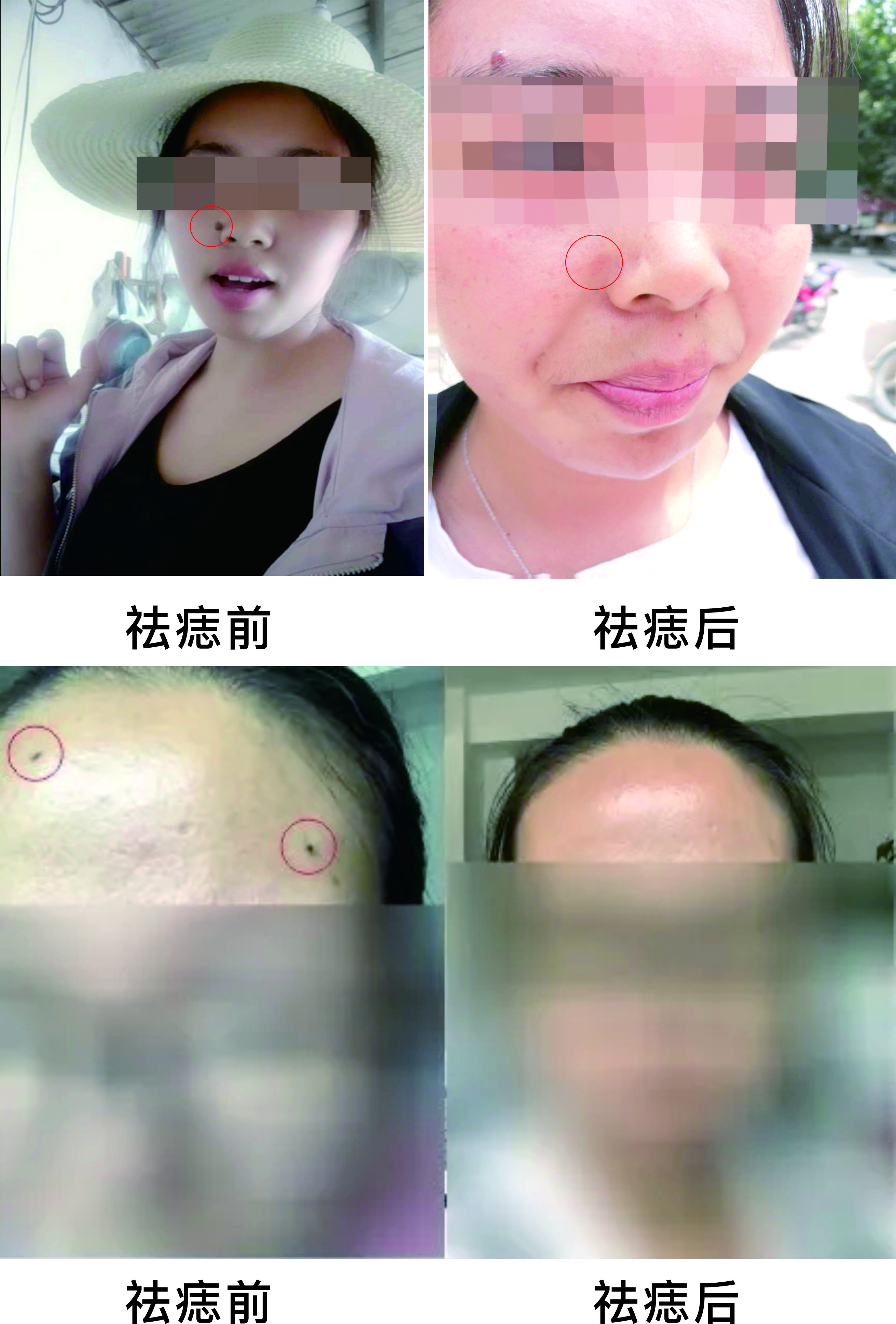微波祛痣，告別臉部多余的“點(diǎn)綴”~