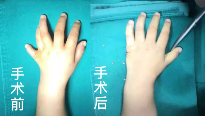 【保山安利醫(yī)院】2歲小兒手、足多指（趾）成功修復(fù)(矯正）！