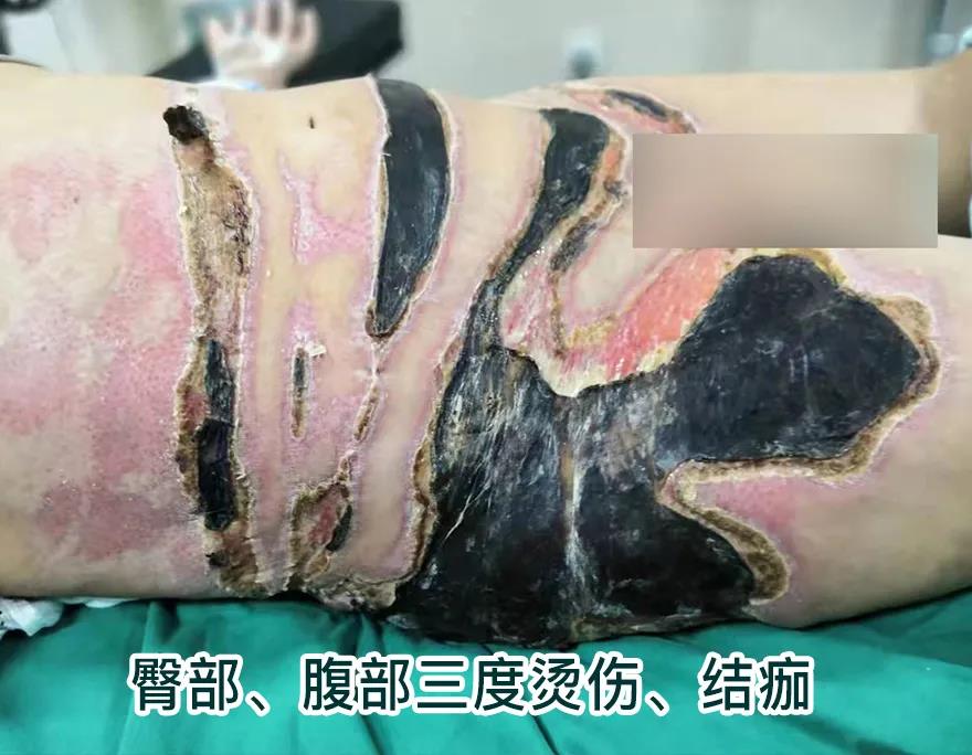 【保山安利醫(yī)院】80歲老人不慎燒傷，導(dǎo)致腹部、右側(cè)臀部大面積創(chuàng)傷，經(jīng)植皮治療創(chuàng)面逐漸愈合