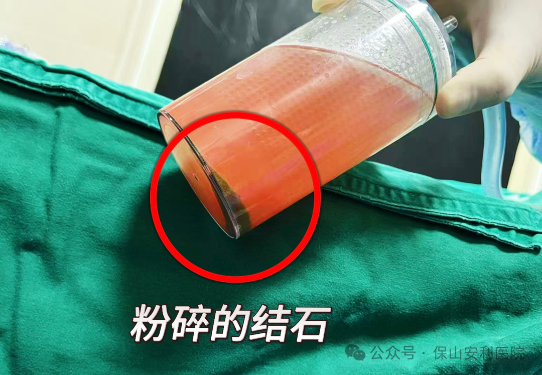 科普丨泌尿結(jié)石“克星”鈥激光碎石術(shù)，手術(shù)動(dòng)圖揭秘全過程！
